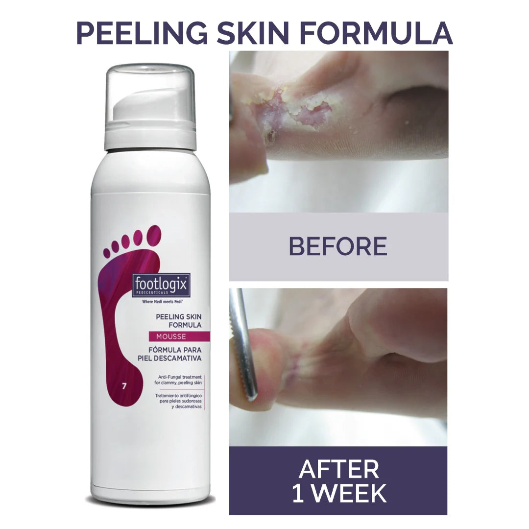 PEELING SKIN FORMULA